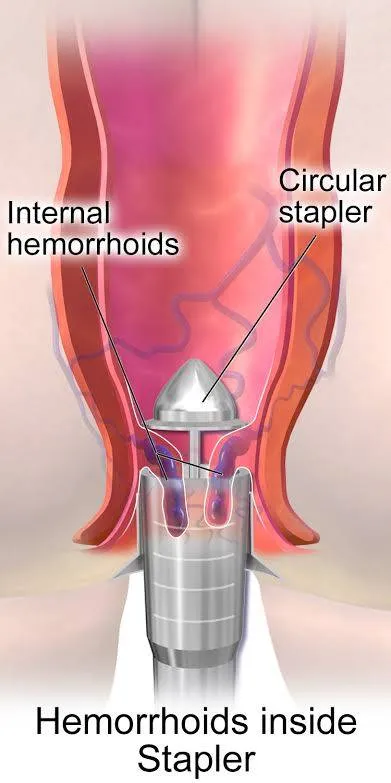 Surgical Procedures for Piles
Only a small percen...