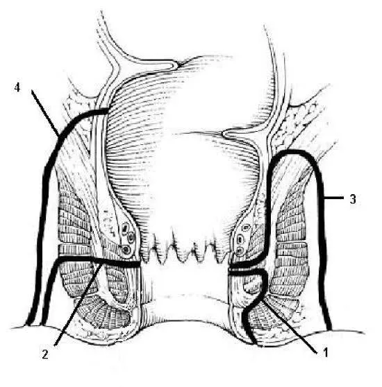 A range of treatment options for Anal Fistula:-
T...