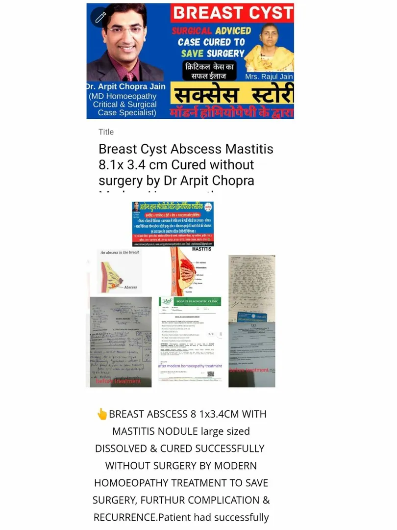 Breast Cyst 8.1 x 3.4 cm large Abscess Mastitis Cu...