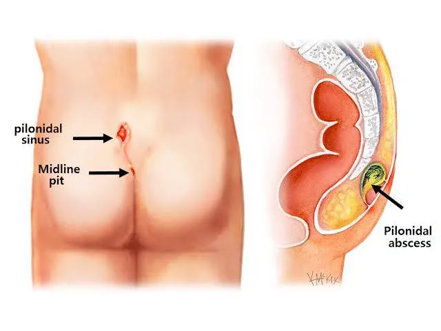 Prevention of Pilonidal Sinus or
Pilonidal cyst
T...