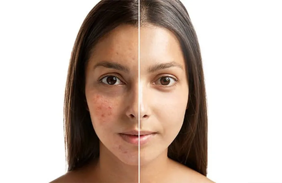 The Ayurvedic Approach To Treat Acne & amp; Pimple...