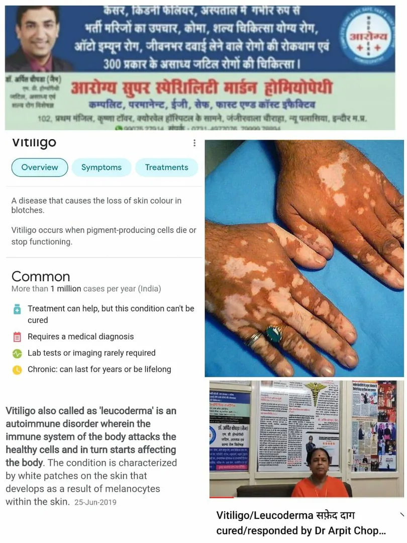 सफ़ेद दाग Vitiligo/Leucoderma cured/responded for A...