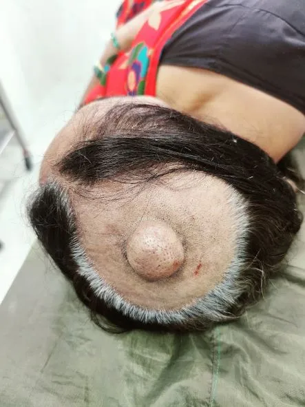 Sebaceous Cysts If you find a yellow or white lump...