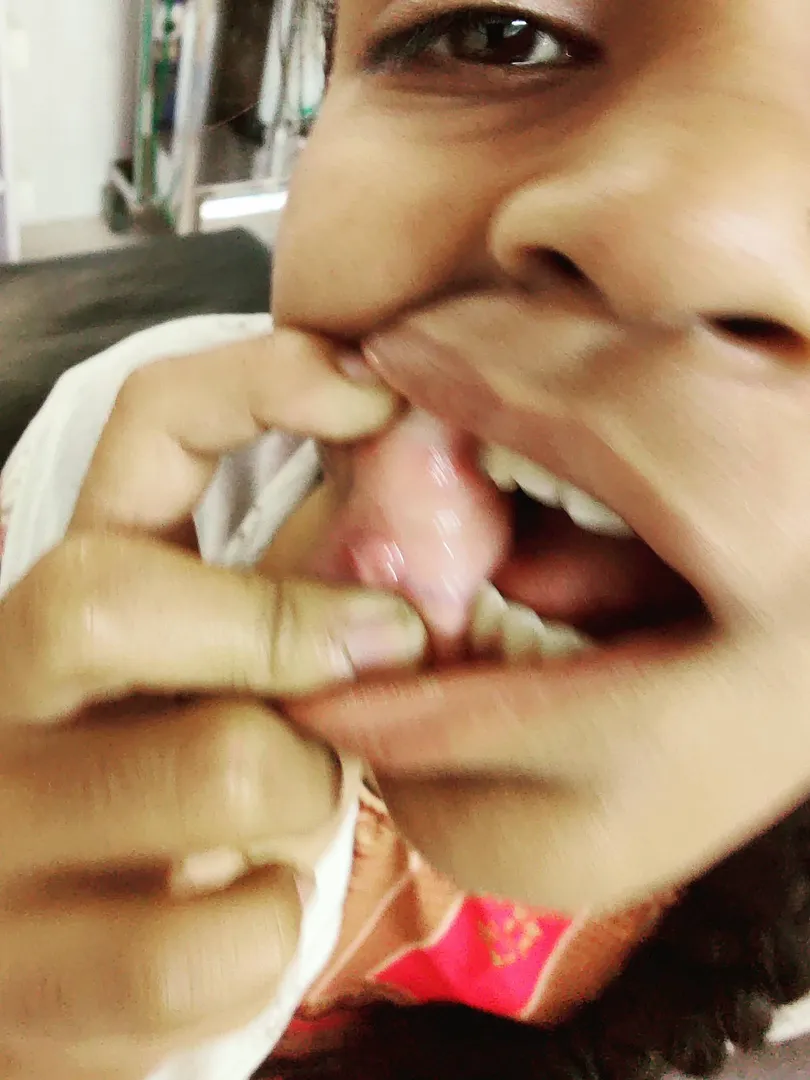 What are mucous cysts?
A mucous cyst, also known ...