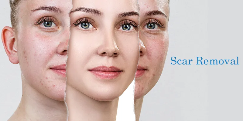 Accidental Scar Treatment in Janakpuri -
If you ...