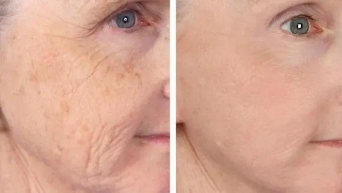 Laser Anti Ageing Treatment in Janakpuri -
If yo...
