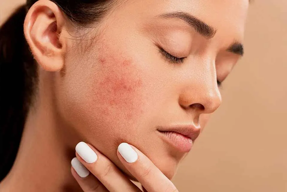 Acne Treatment in Janakpuri -
Acne is a very com...