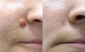 Mole Removal in Janakpuri -
Moles are common ski...