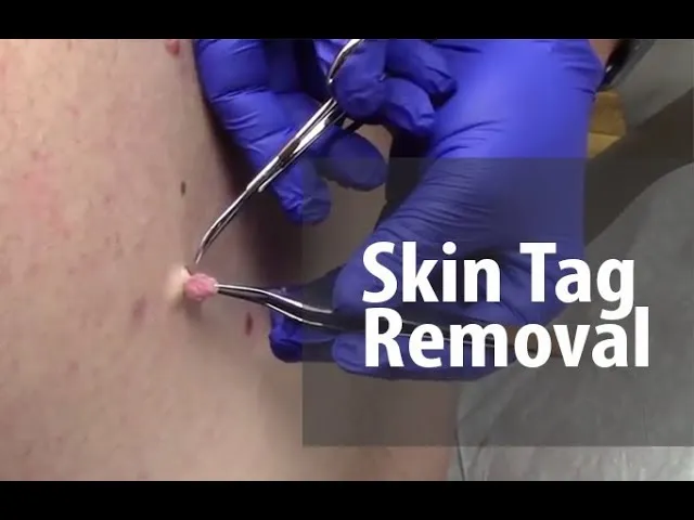 Skin Tag Removal in Janakpuri -
Skin tags are pa...