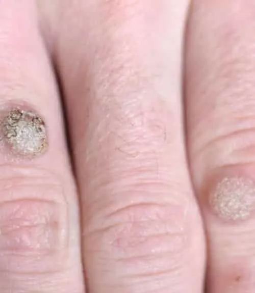 Warts Removal in Janakpuri -
Warts are small gro...