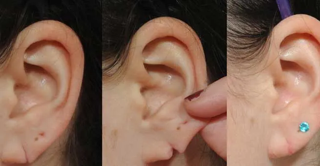 Lobuloplasty in Janakpuri -
Lobuloplasty is the ...