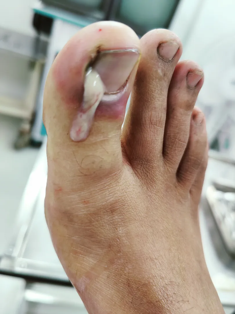 Paronychia is inflammation of the fingers or toes ...