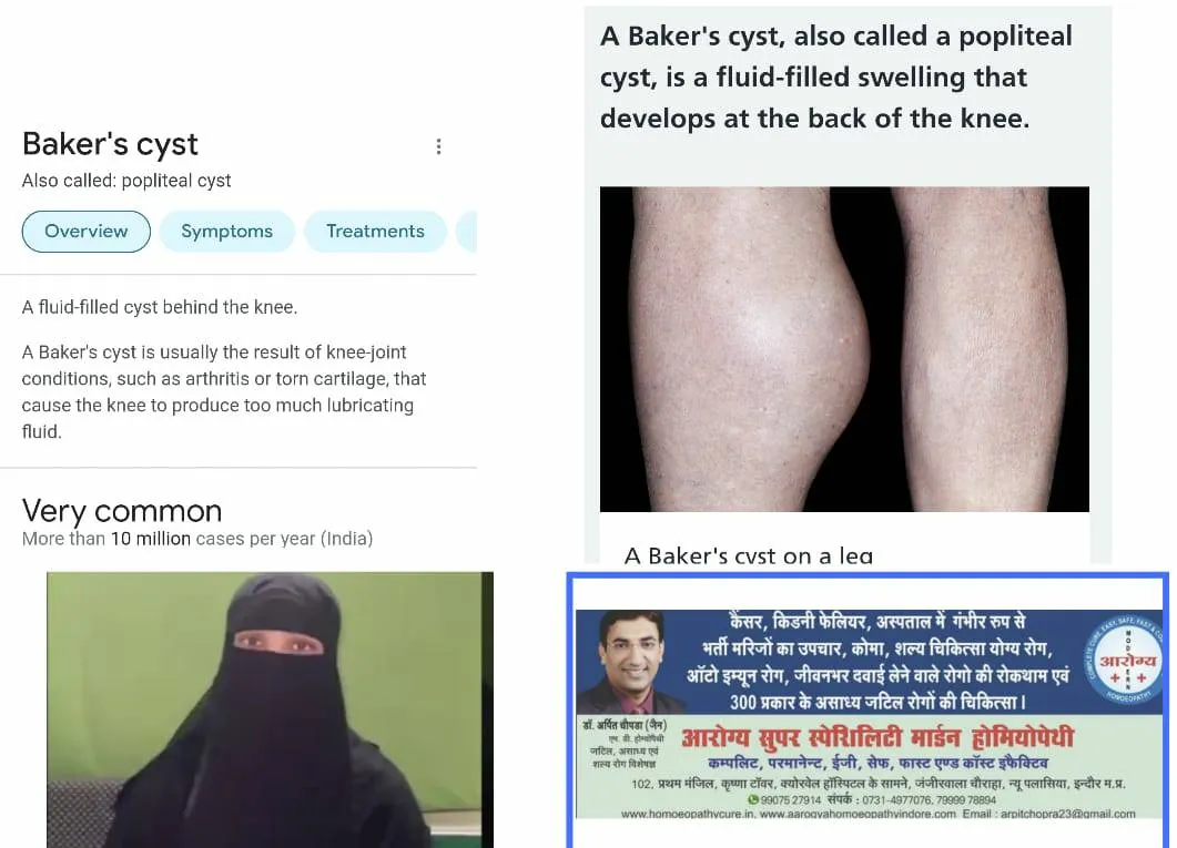 KNEE ARTHRITIS WITH BAKER'S CYST CURED WITHOUT SUR...