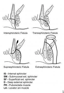 Types of Fistula in ano ( Bhagandar):-
The classif...