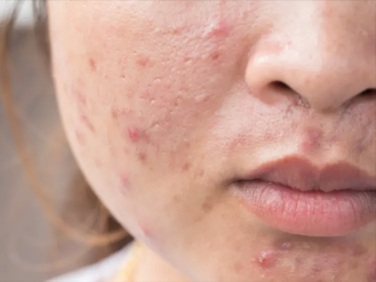 Isotretinoin is a medicine used to treat very bad ...