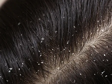 Dandruff occurs, essentially, when small bits of d...