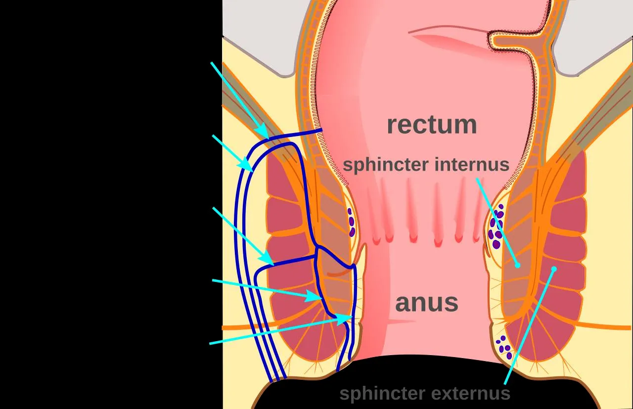 The signs and symptoms of an anal fistula include:...