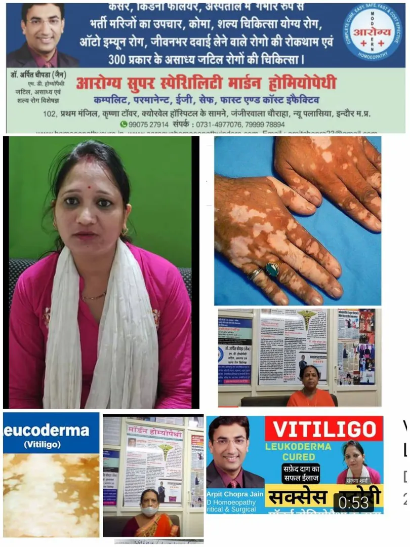 सफ़ेद दाग Vitiligo/Leucoderma cured/responded for A...