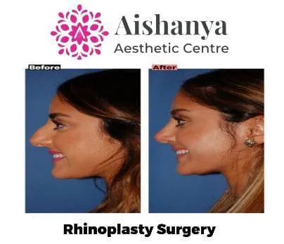 Best Rhinoplasty Centre in Janakpuri and Delhi
...