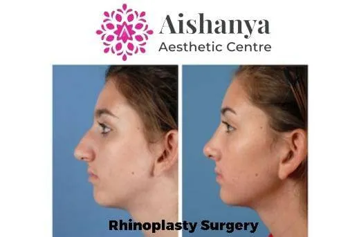Rhinoplasty Surgery is a Combination of Art with S...