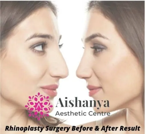 Best Rhinoplasty Centre at Janakpuri and Delhi
...