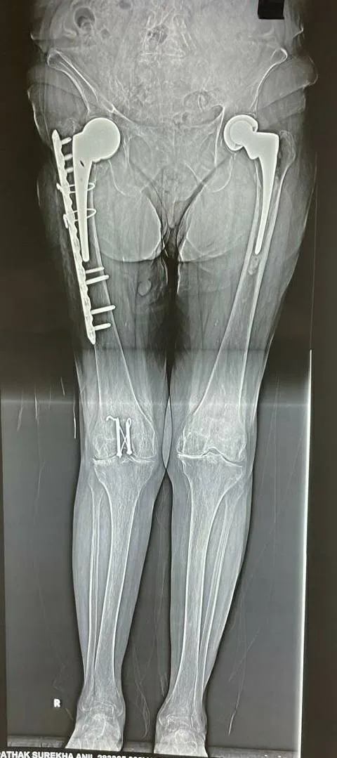 Arthritis rt knee operated by robotic technology -...
