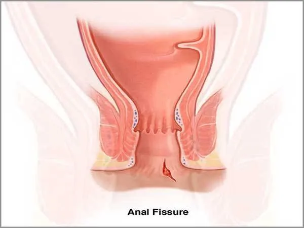 Fissurectomy is one of the options among those tec...