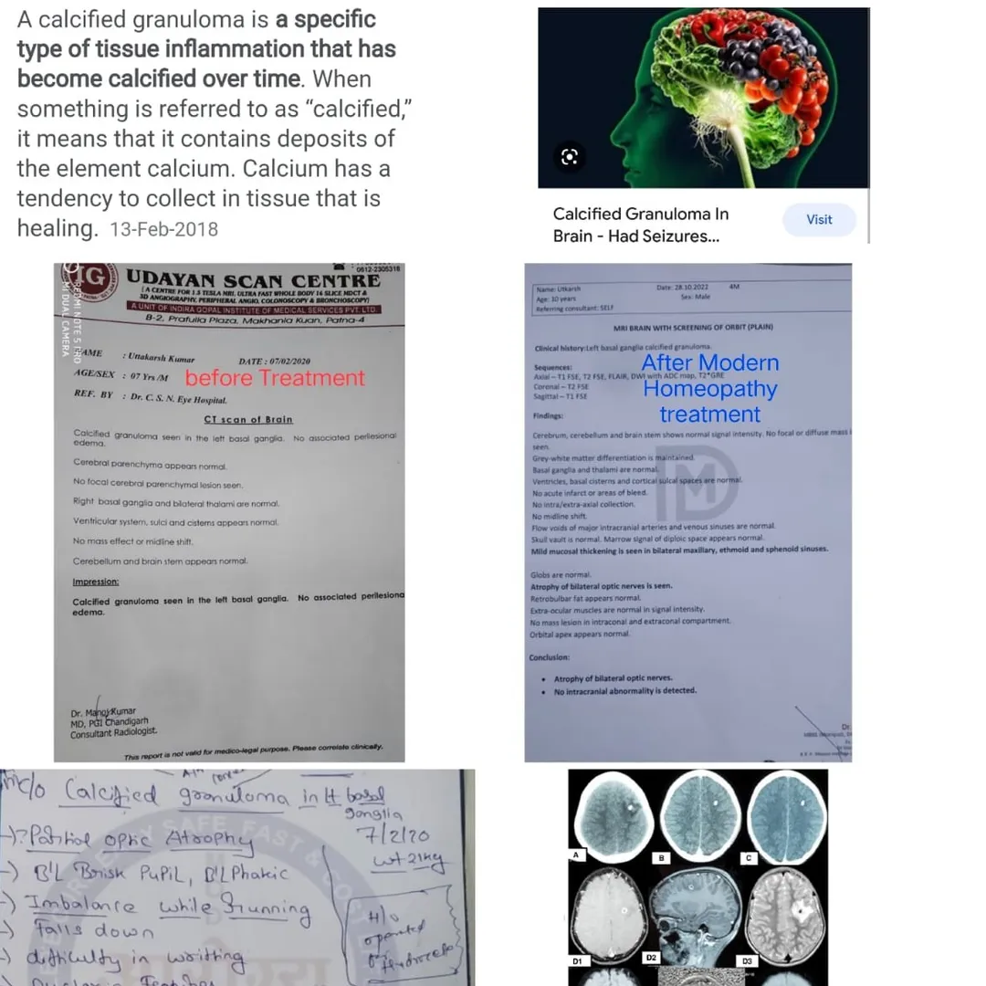 Calcified Granuloma Brain Tumour/ Lesion cured/dis...