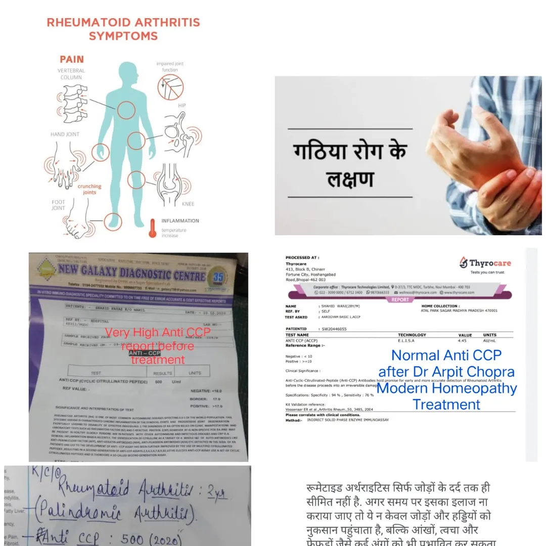 Rheumatoid Arthritis गठिया responded Very High Ant...