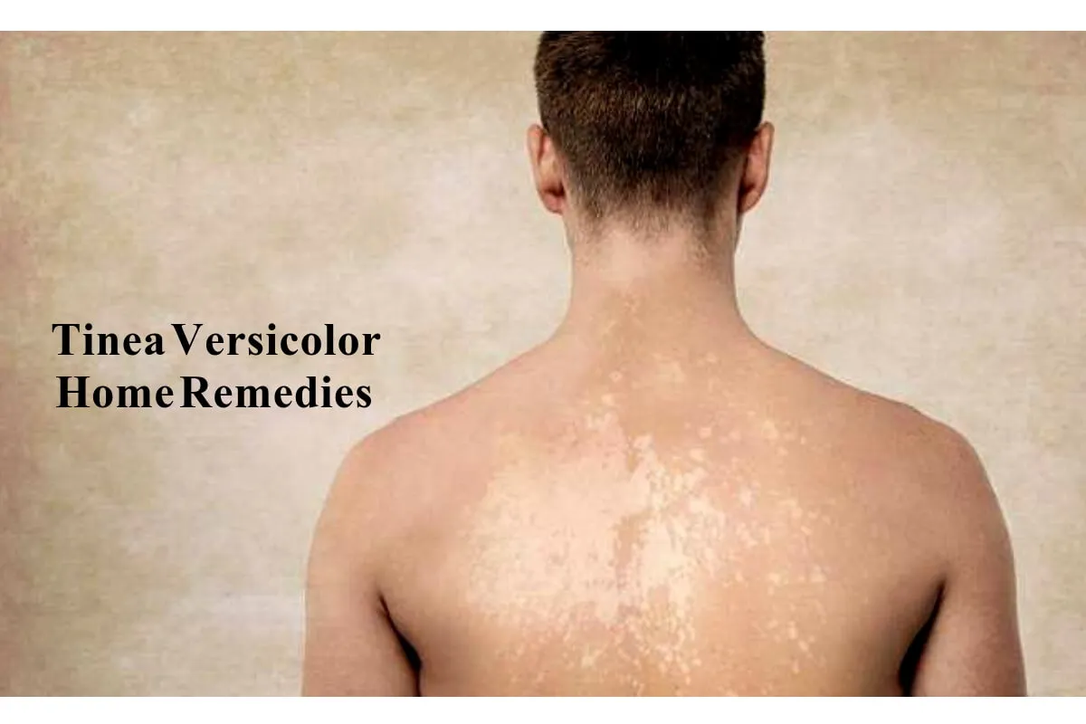 Tinea versicolor
Overview
Tinea versicolor is a c...
