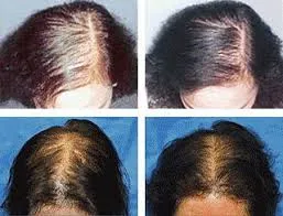 Hair Laser is a safe, non-invasive and clinically...