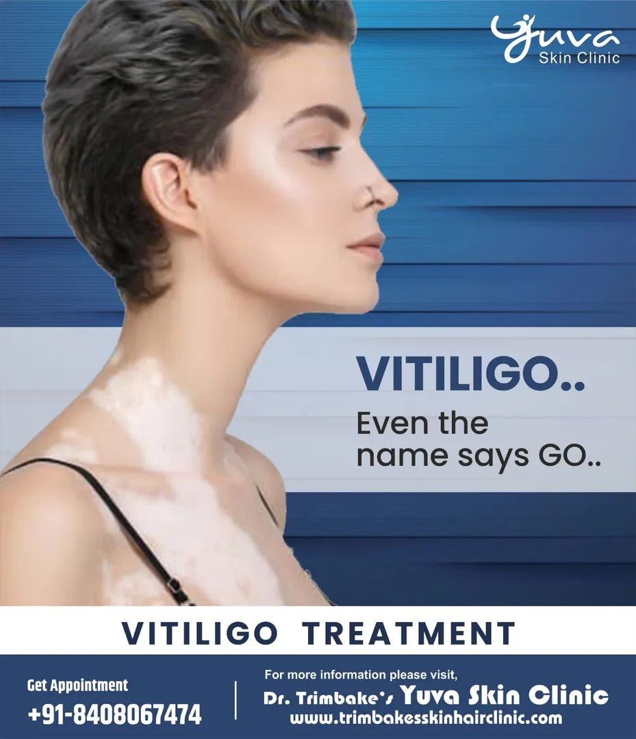 Vitiligo Treatment - Vitiligo is a genetic and aut...