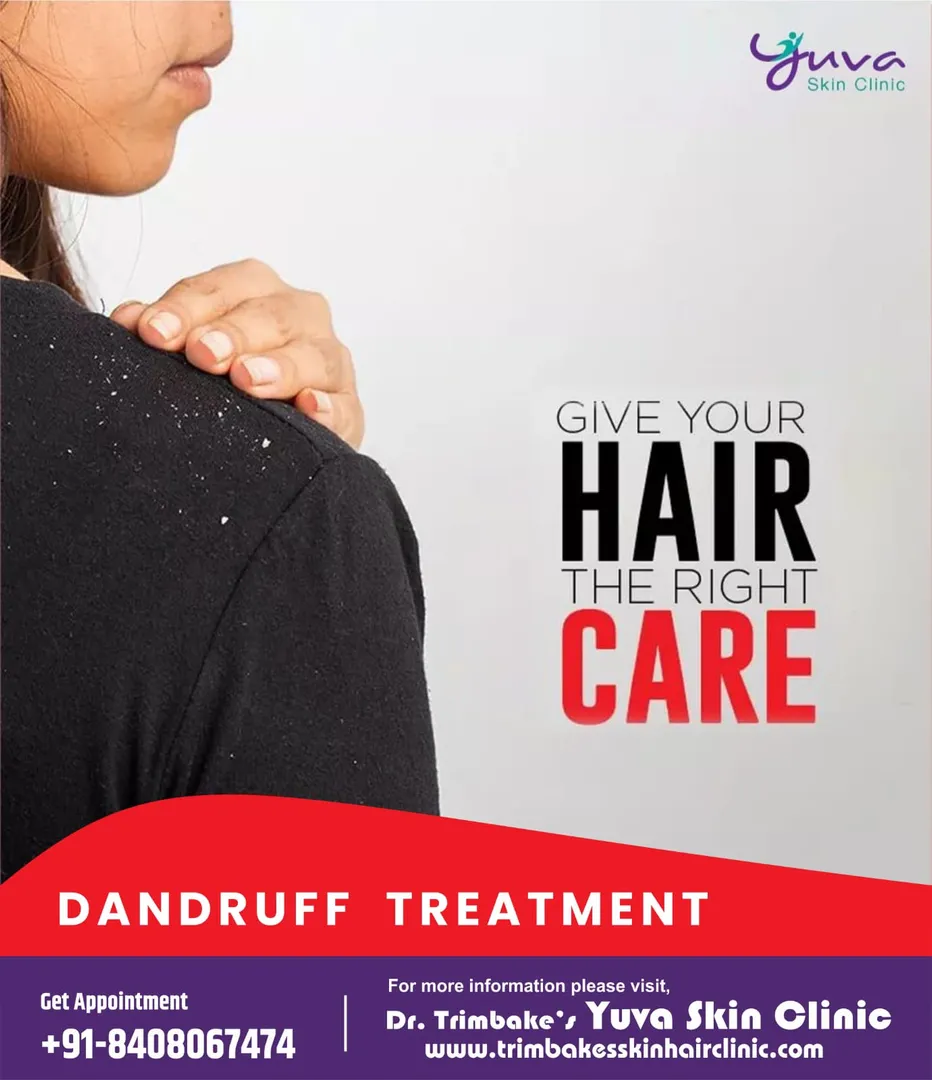 Dandruff is the excess shedding of the top layer o...
