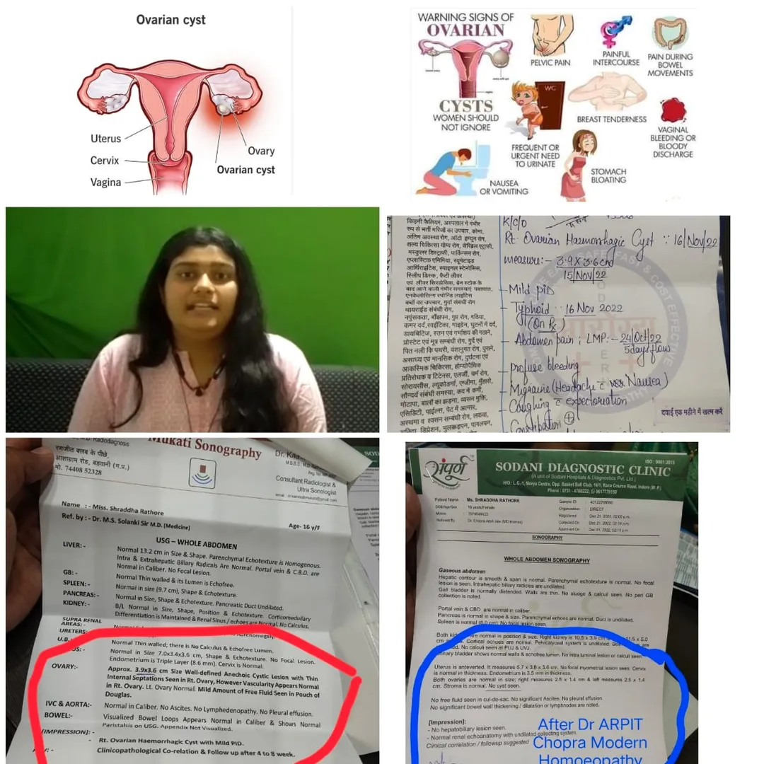 Ovarian Cyst Large 3.9x3.6 cm cured only in 1 mon...