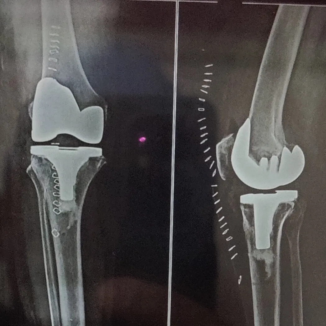 Robotic knee replacement surgery
we started Robot...
