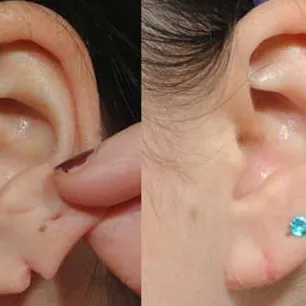 Ear Lobe Repair in Janakpuri -
Dr Saloni is one ...