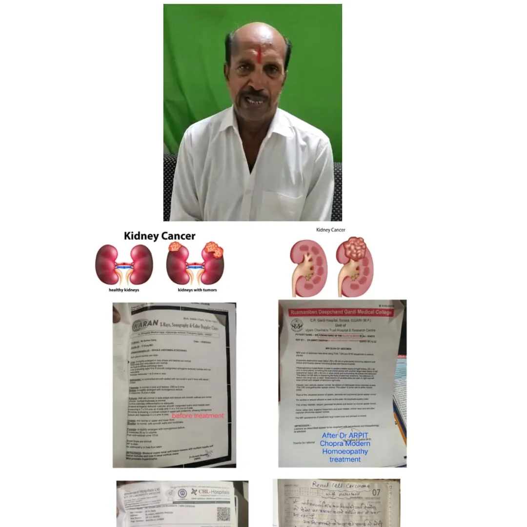 Renal Cell Carcinoma very Large 11.4 cm mass RCC K...