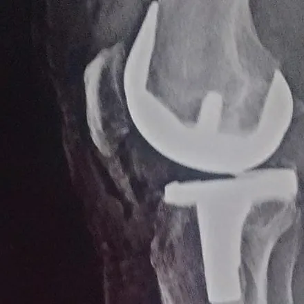 Robotic knee replacement surgery
shashwat hospita...