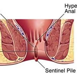 Sentinel piles are common, usually harmless, grow...