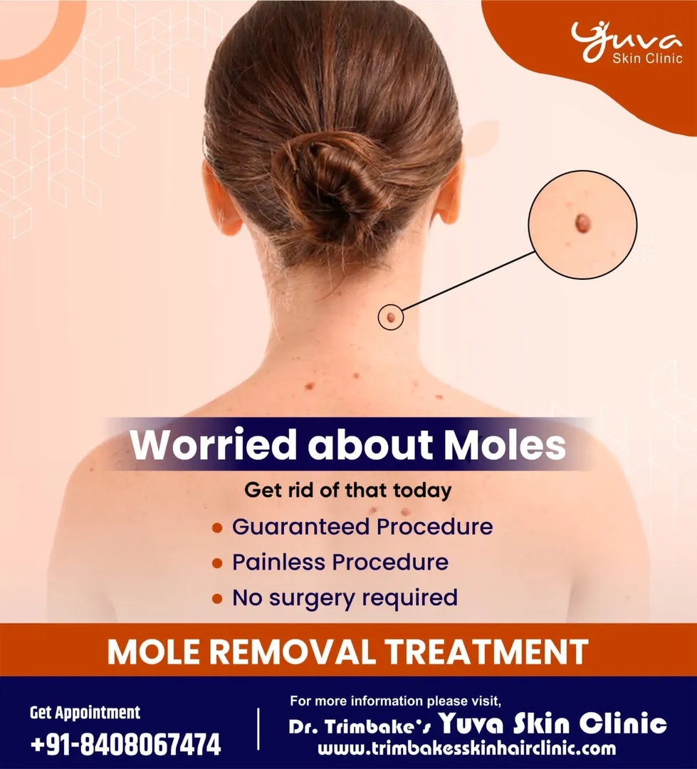 Mole removal and wart removal treatment is all abo...
