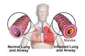 A pulmonologist, also known as a chest physician o...