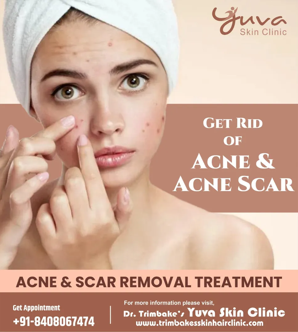 Acne & Acne Scar Treatment
Acne can be a nightmare...