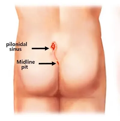 #LASER #PILONIDOPLASTY:-
Laser Surgery for Pilonid...