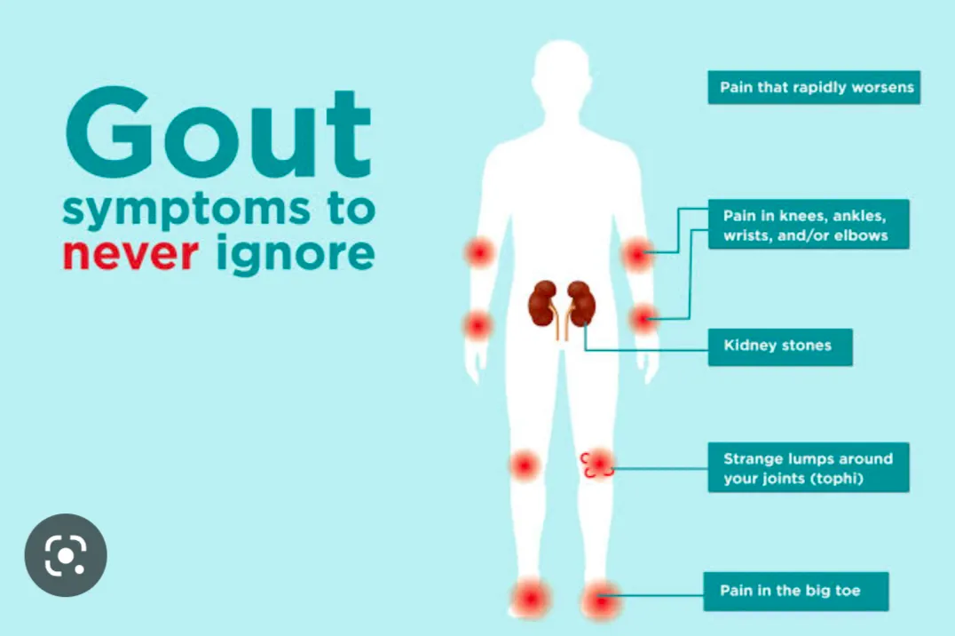 Gout is form of inflammatory arthritis that occurs...