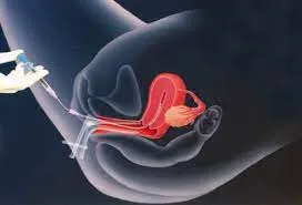 Uttarbasti in infertility
Ayurveda is a science,...