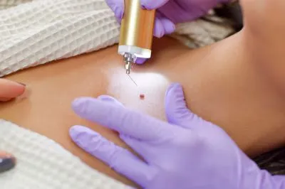 Laser Treatment For Birthmarks In Nashik
Birthmar...