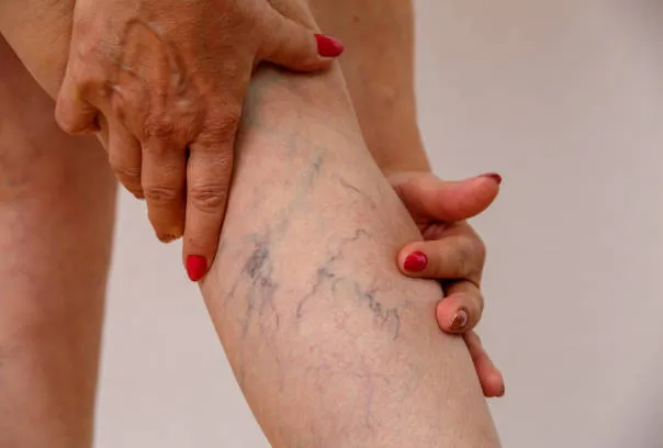 Vericose Vein
Veins that are dark purple or blue...