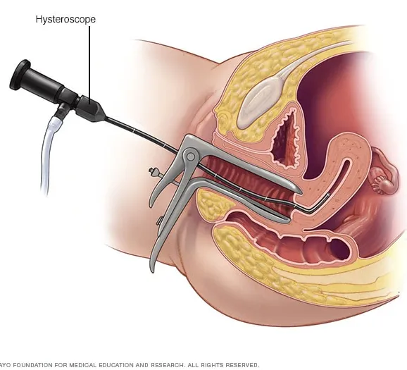Dilation and curettage (D& C)
Dilation and curett...
