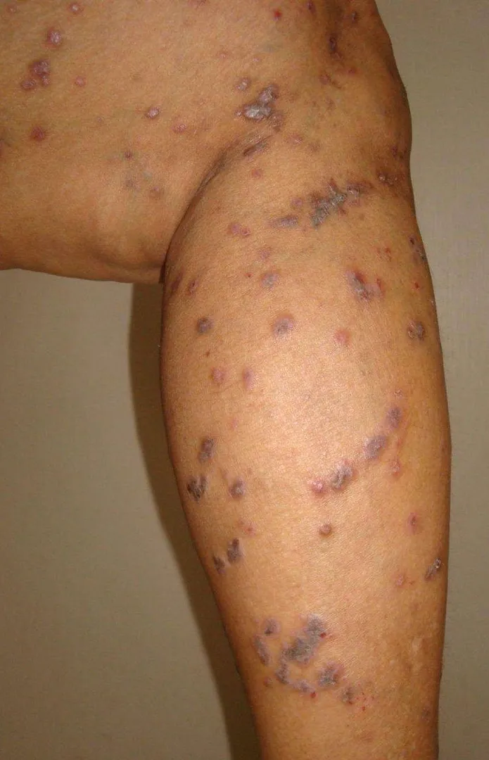 Ayurvedic Treatment for LICHEN PLANUS Lichen planu...