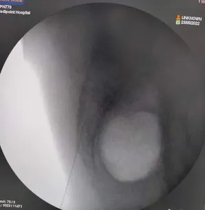 Caudal injections are a type of epidural injection...